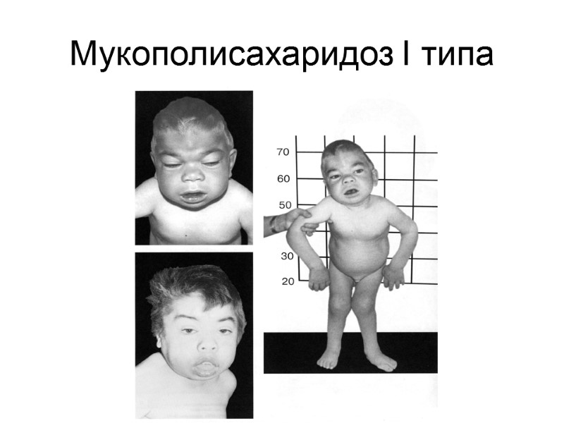 Мукополисахаридоз I типа